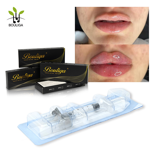 אספקת מפעל מילוי עור של חומצה היאלורונית להזרקה לקמטים מילוי שפתיים 1 מ'ל עמוק